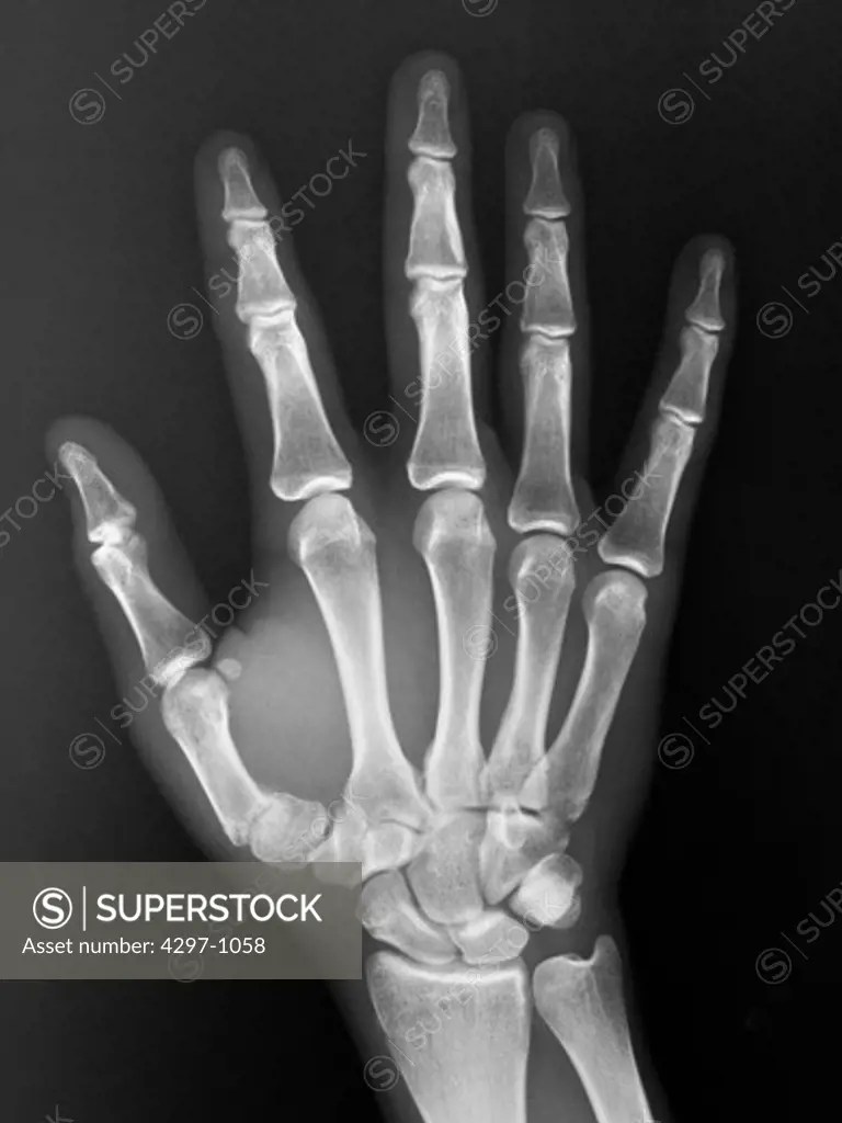 Normal hand xray of a 19 year old boy SuperStock