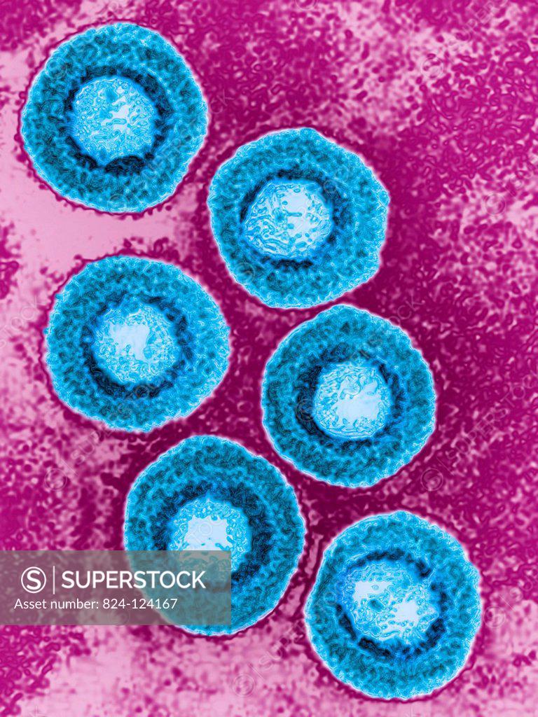 Varicella zoster virus (human herpesvirus type 3, HHV3). It causes