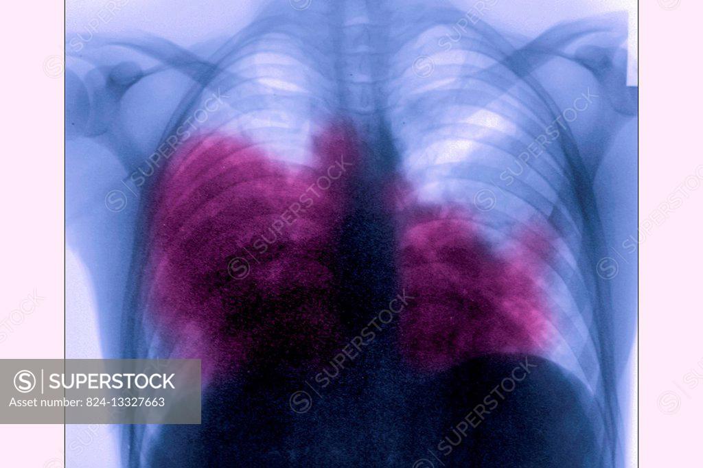 Acute bilateral pneumonia (legionnaires? disease caused by Legionella