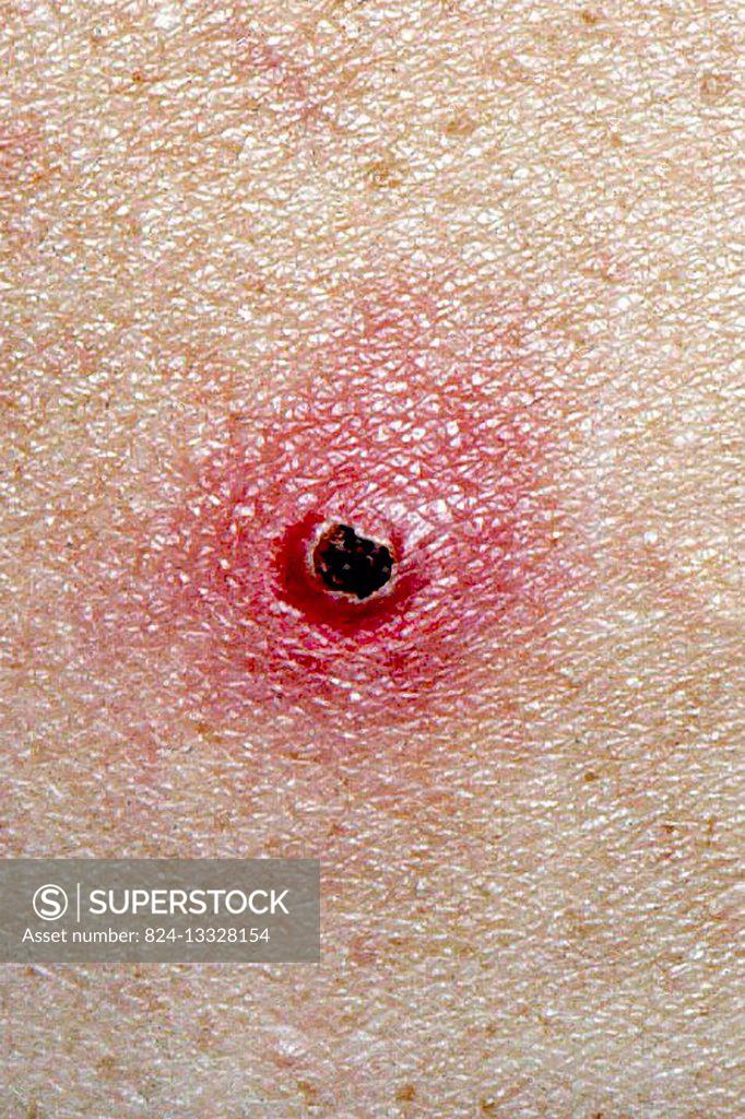 Catscratch disease, (benign inoculation lymphoreticulosis). SuperStock