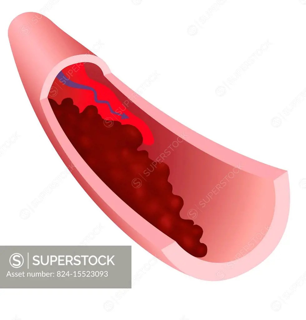 Thrombosis is a blood clot that forms in a vein (venous thrombosis) or an artery (arterial