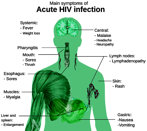 Understanding AIDS Symptoms, Causes, and Treatment