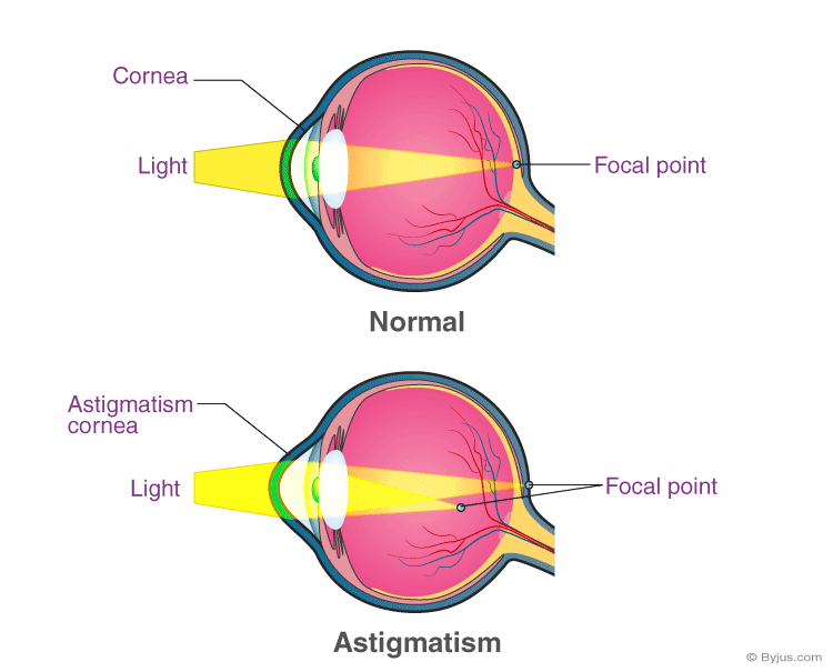 Understanding Astigmatism: Causes, Types and FAQs