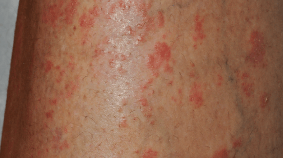 42YearOld Female with Psoriasis and NewOnset Rash The Doctor's Channel