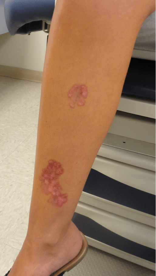22YearOld Female With Lobular Plaques on Shin The Doctor's Channel