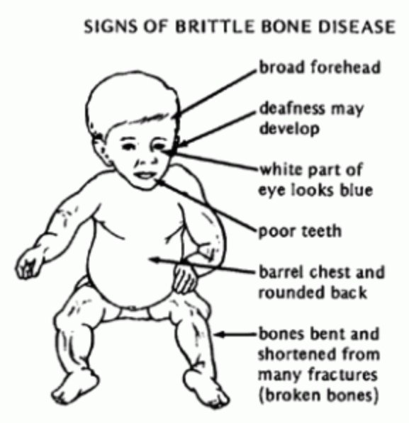 Osteogenesis Imperfecta