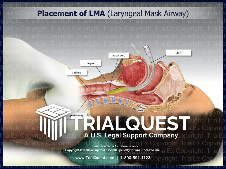 Placement of LMA (Laryngeal Mask Airway) Trial Exhibits Inc.