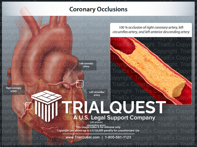 Coronary Occlusions TrialExhibits Inc.