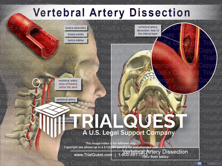 Vertebral Artery Dissection TrialExhibits Inc.