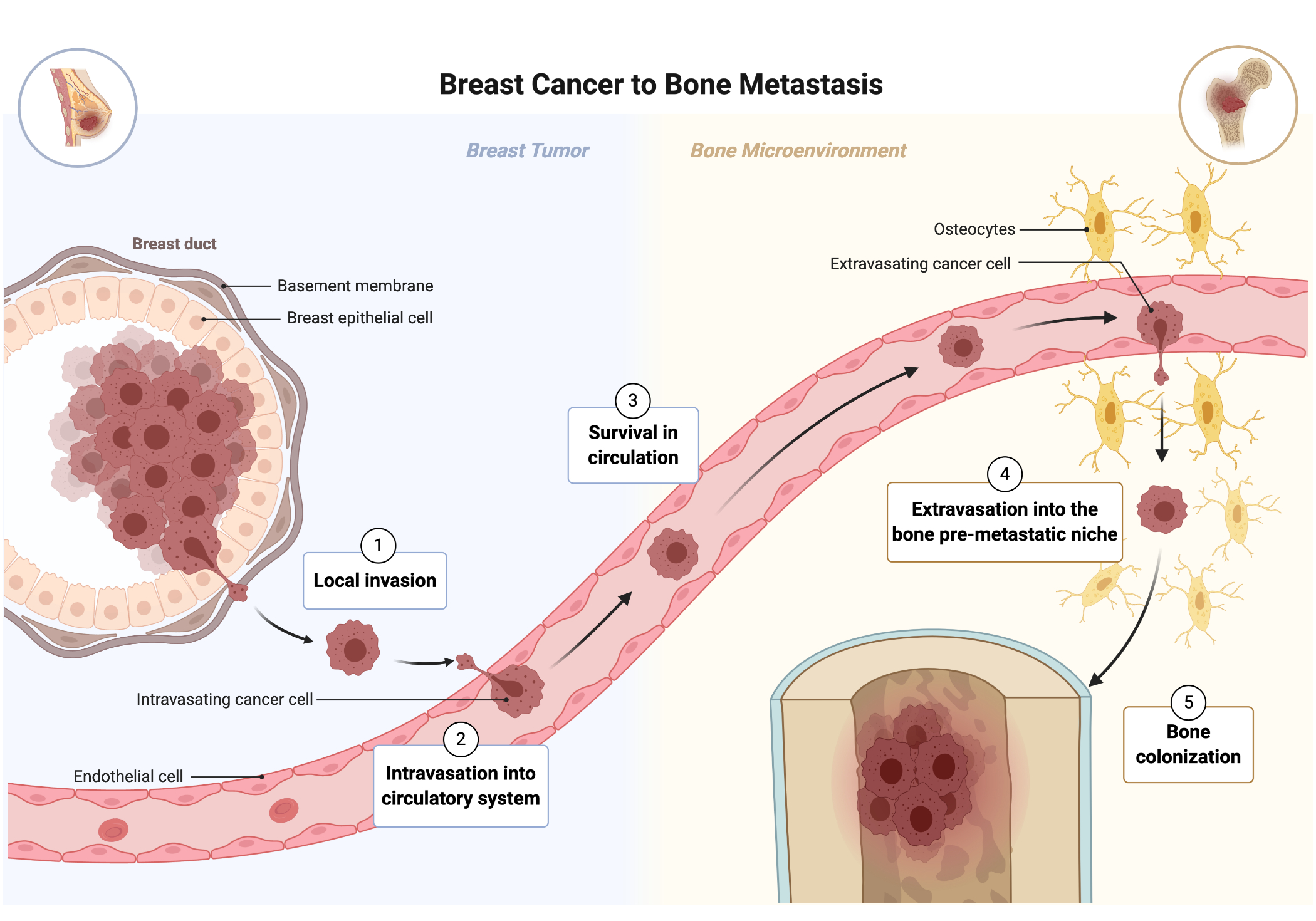 Breast Cancer Metastasis to the Bone Microenvironment Young Scientist