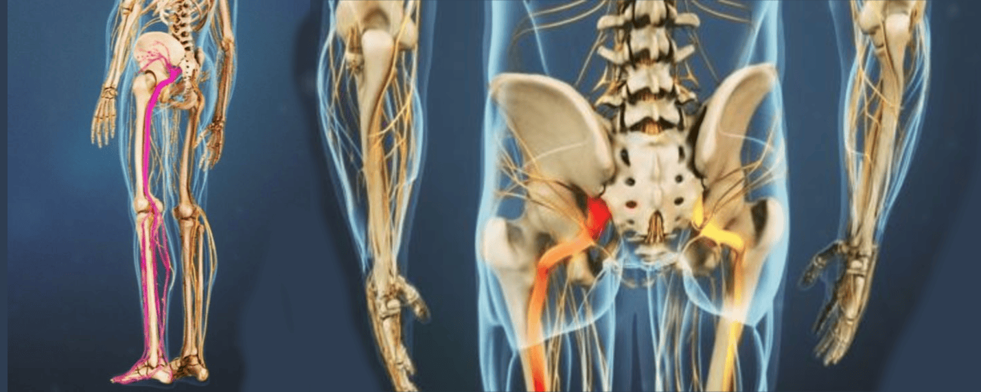 Sciatic Pain Treatment Orange City FL