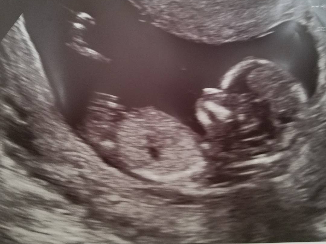 Gender At 12 Weeks 5 Days ovulation signs