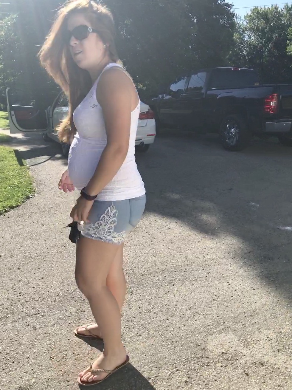 Posterior baby bump (flat spot/sunny side up baby)