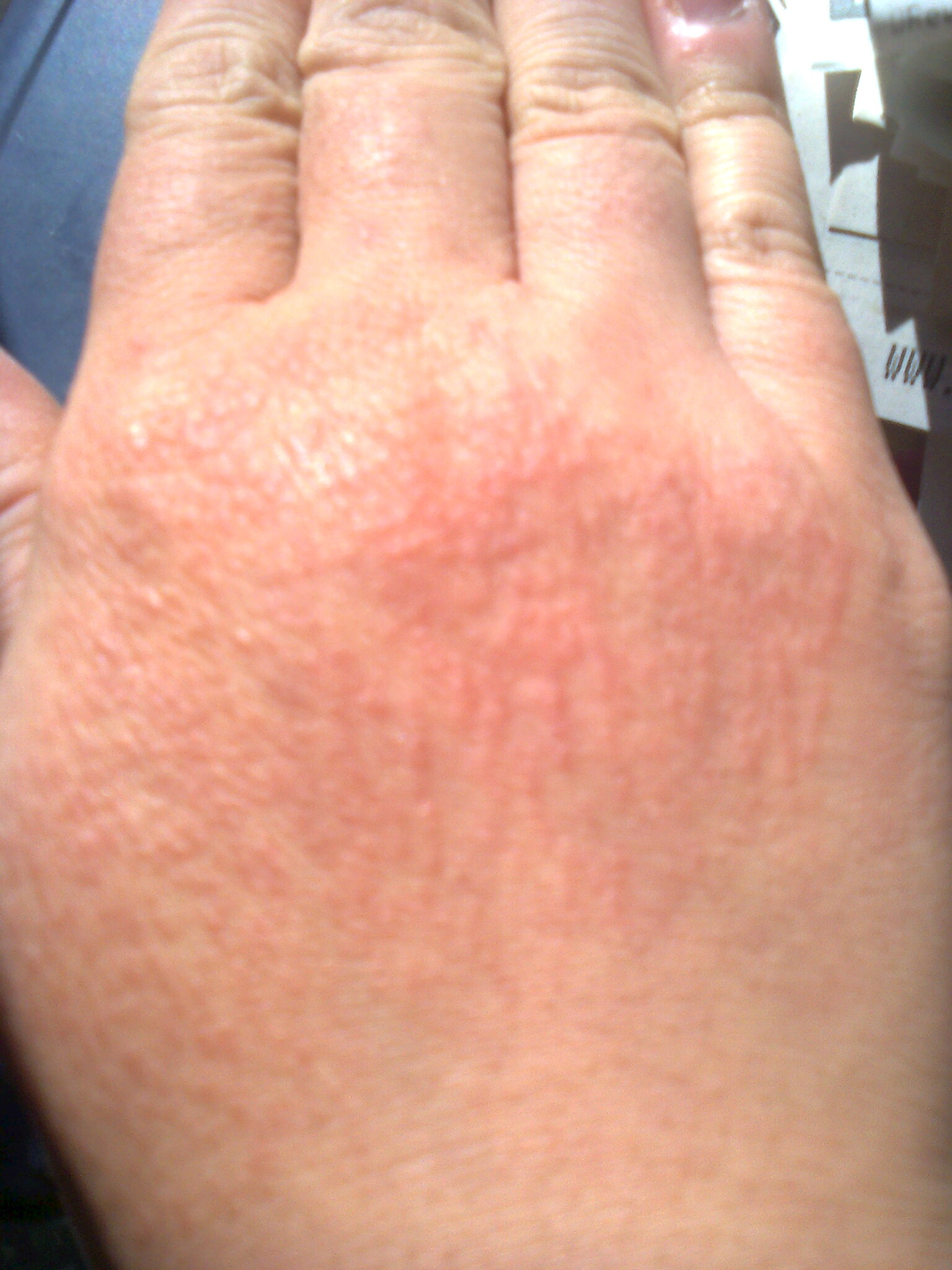 Itchy hands/rash help?