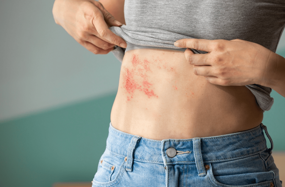 Zona Nedir? Zona Belirtileri ve Zona Tedavisi | WM Aracı