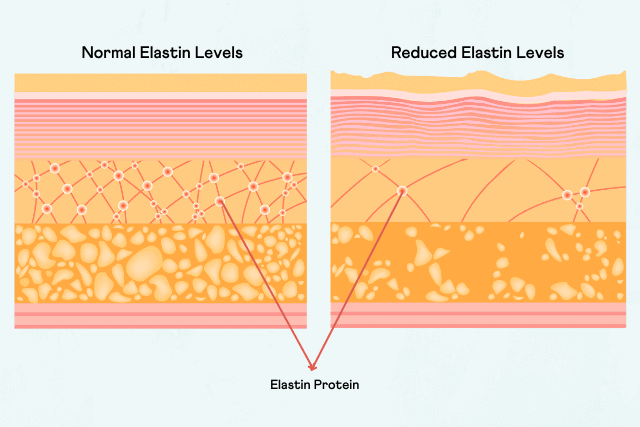 How It Works Stretch Marks And Genetics