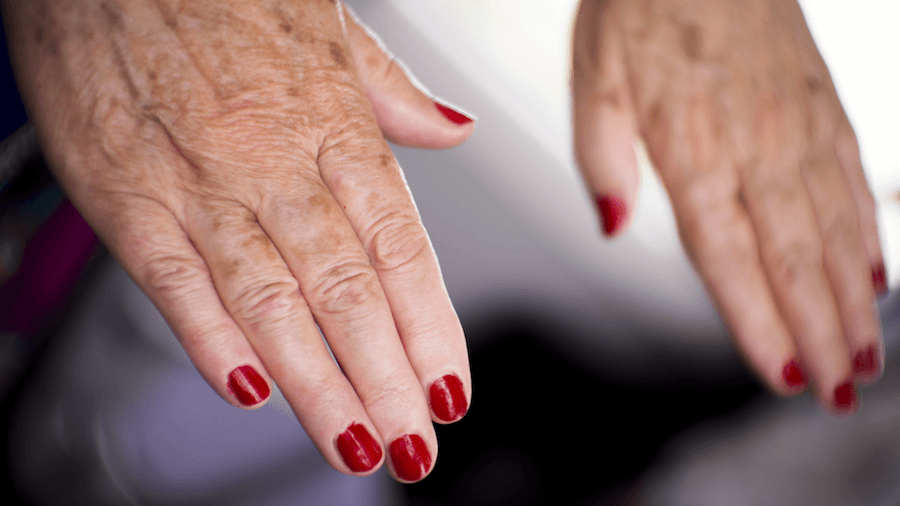 Is Lupus Hereditary? An Overview of Factors Xcode Life