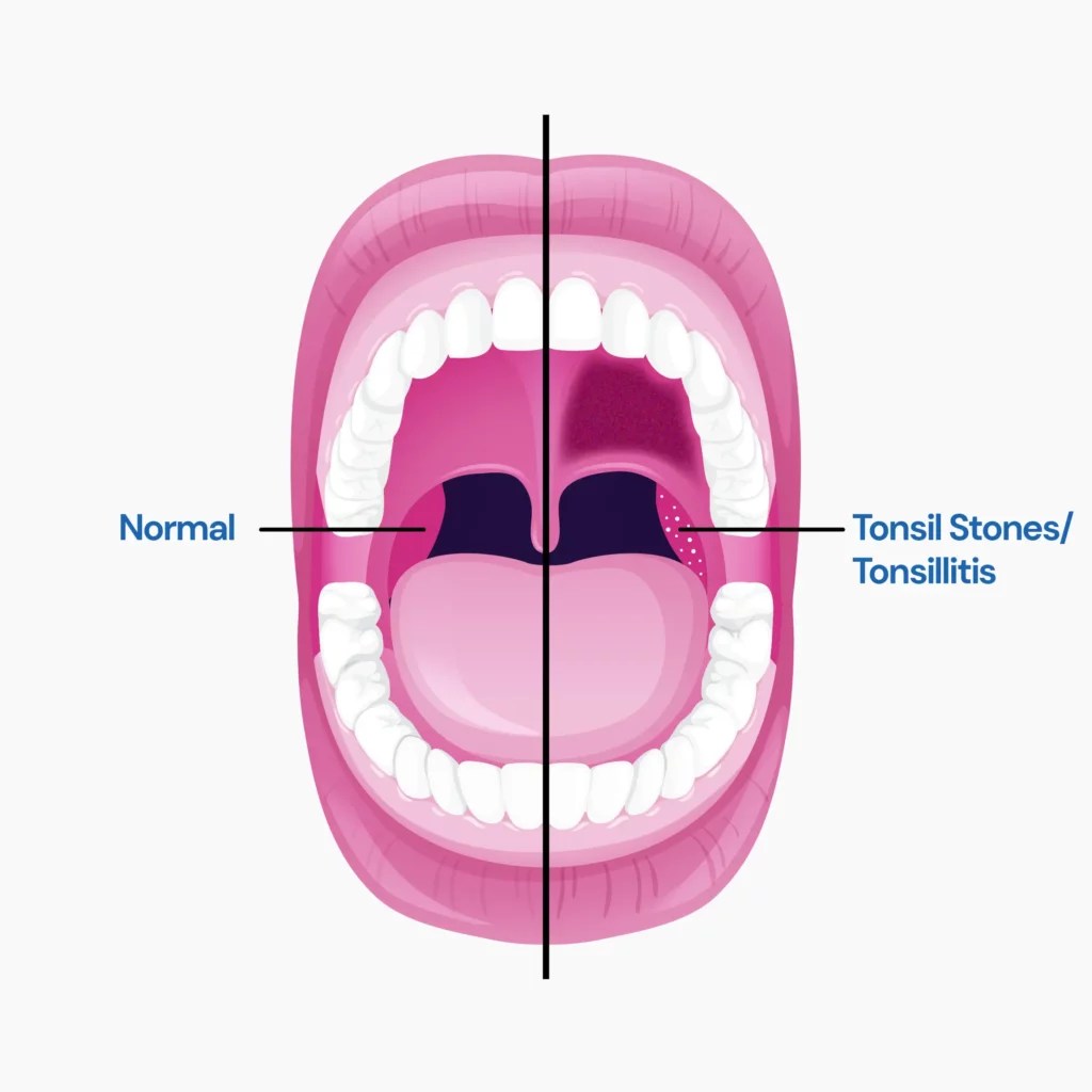 Tonsil Stones vs Strep Is There A Difference?