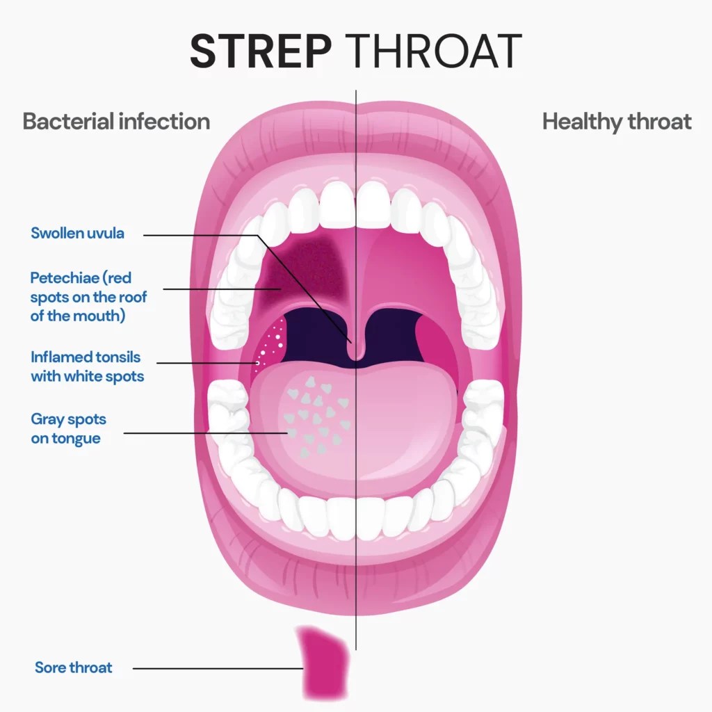 Tonsil Stones vs Strep Is There A Difference?