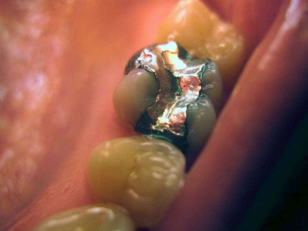 Radical dental procedure regenerates teeth, making fillings obsolete