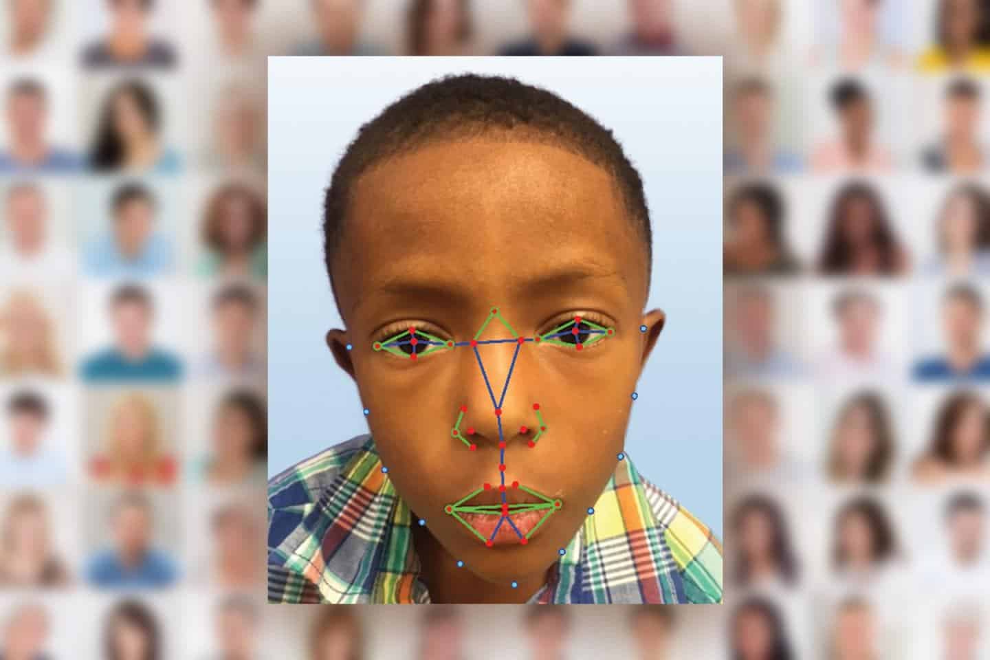 Facial recognition software can diagnose rare disease with 96