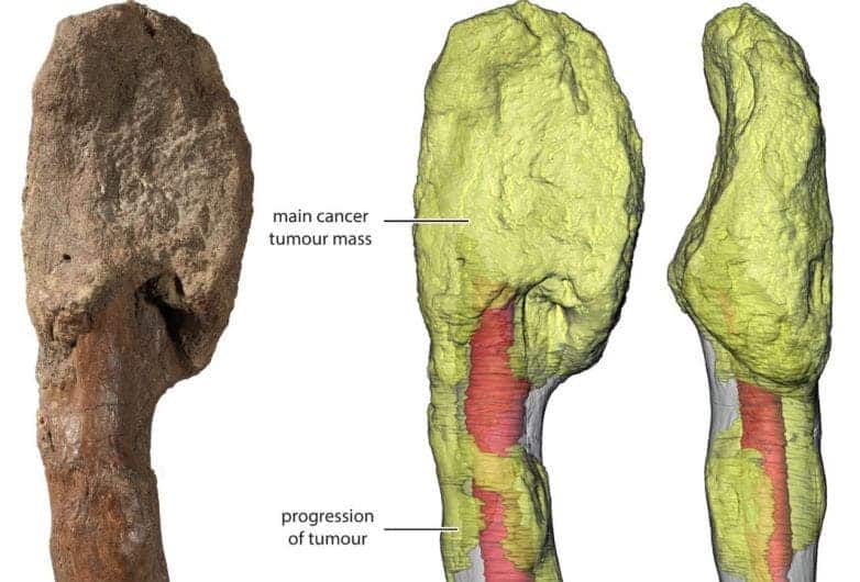 Researchers confirm the first case of bone cancer in dinosaurs