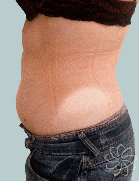 Get rid of stubborn pockets of fat NZ Body Catalyst New Zealand