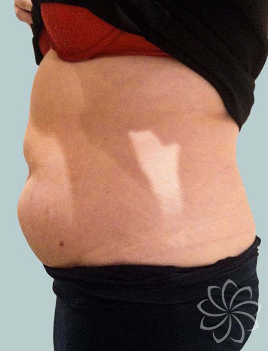 Fat Cavitation Ultrasonic Fat Cavitation Body Catalyst Body