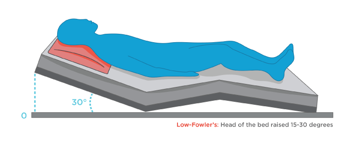 Fowler’s Position Beyond the Bed