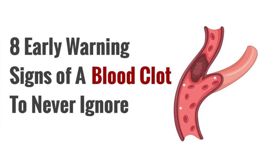What Does a Blood Clot Feel Like? 8 Signs You Should Never Ignore!