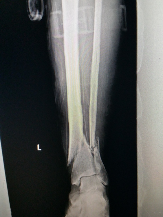 Compound fracture of tibia and fibula recovery