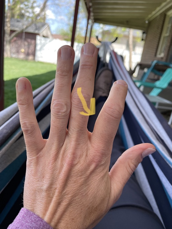 Sprained index finger?