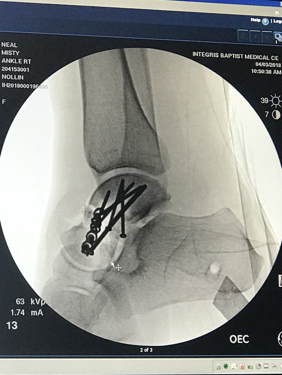Talus fracture and partial displacement, healing advice and support