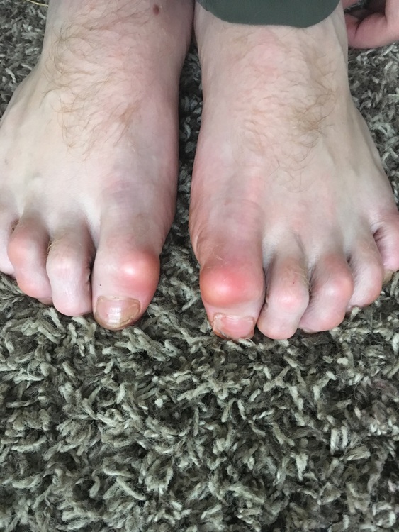 Beginner climber w/ big toe pain...normal?