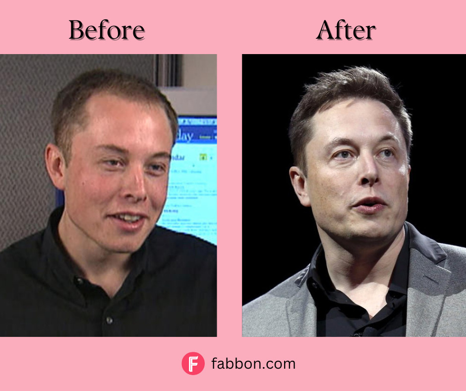 Did Elon Musk Undergo A Hair Transplant? Fabbon
