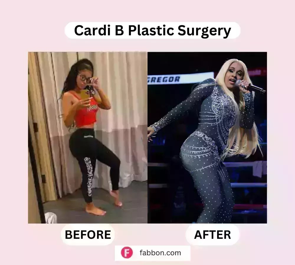Cardi B Plastic Surgery Full Guide Before And After Photos Fabbon