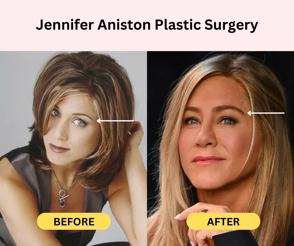 Jennifer Aniston Plastic Surgery Secrets Before And After Photos Fabbon