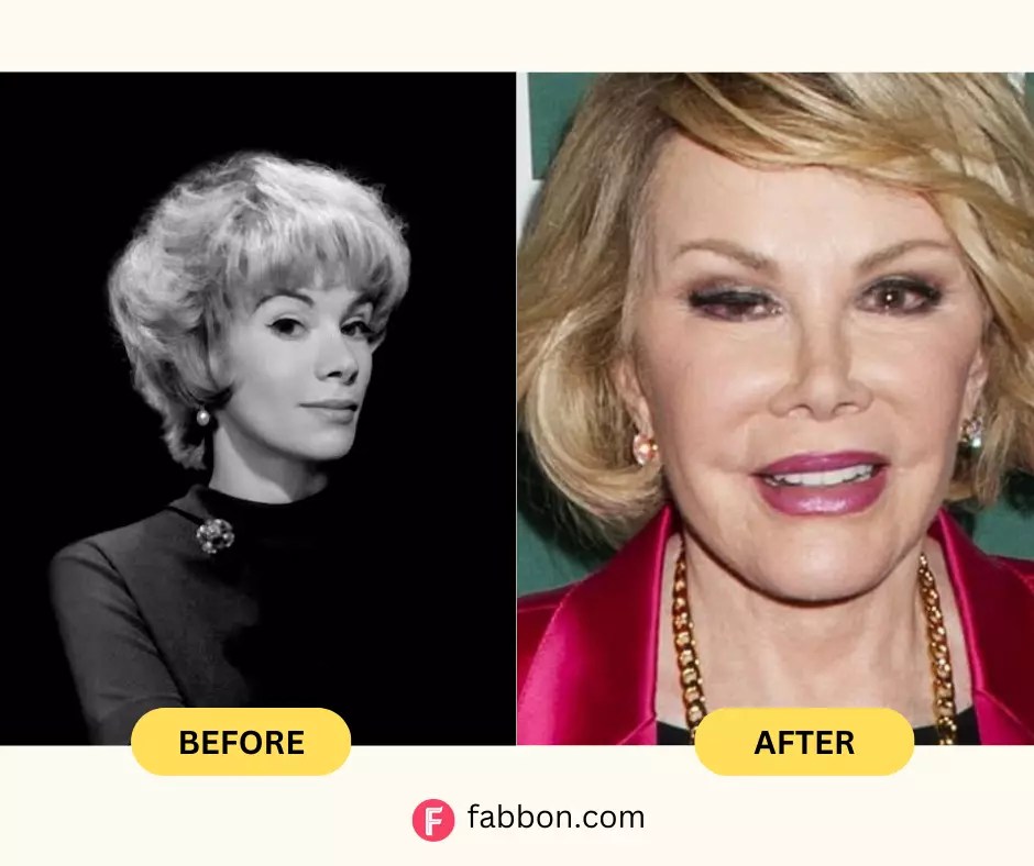 When Plastic Surgery Goes Wrong Lessons from 21 Celebrity Disasters