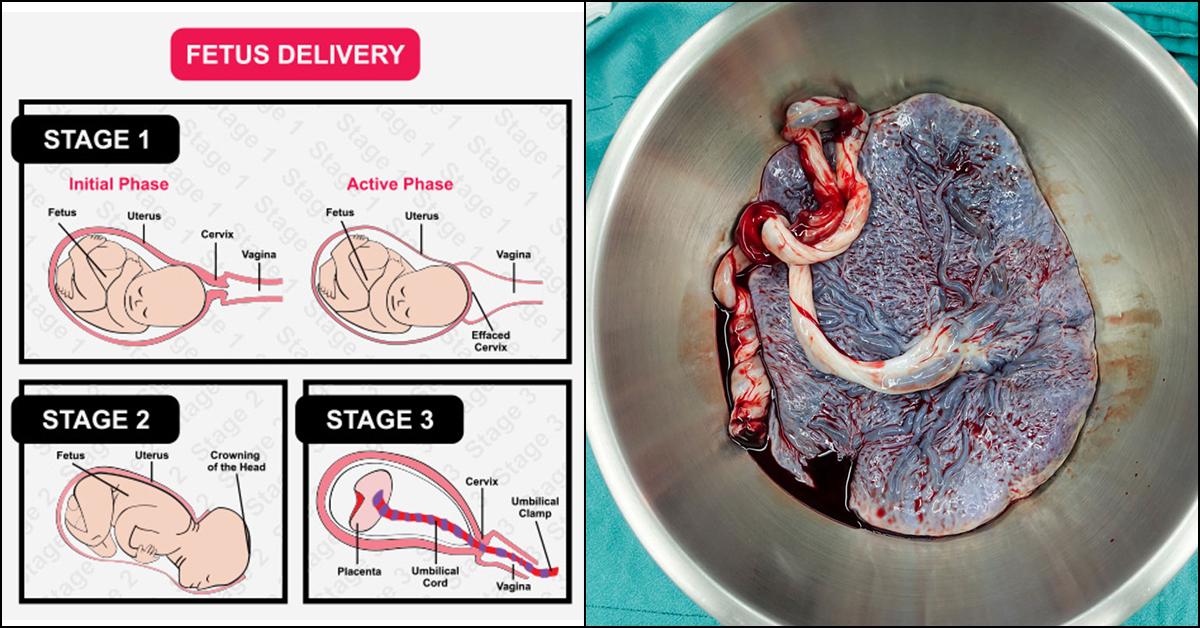 Retained Placenta Causes, Symptoms, And Treatment