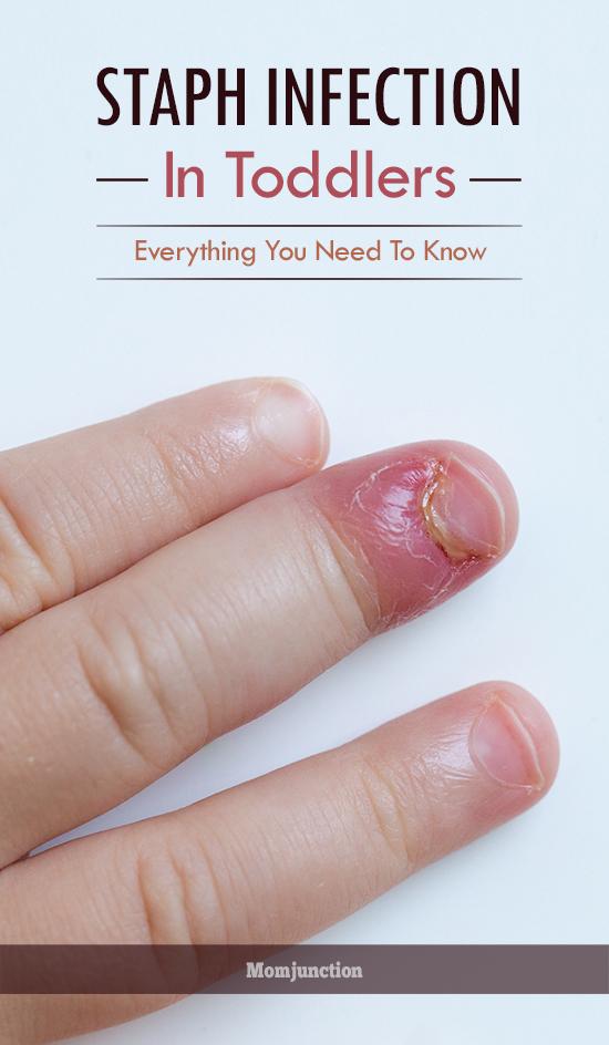 Staph Infection In Toddlers Everything You Need To Know
