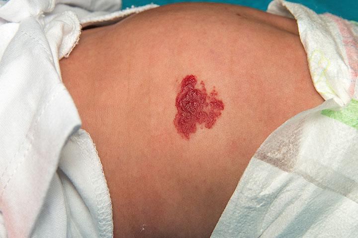 What To Know About Birthmarks Amazing Dreamz