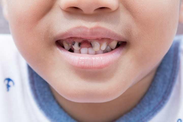 Child Tooth Decay Pictures, Causes And Treatment Options