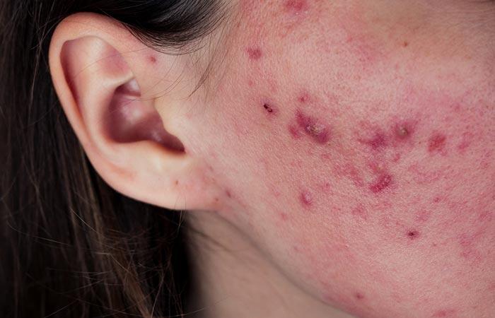 Different Types Of Acne And How To Treat Them Effectively