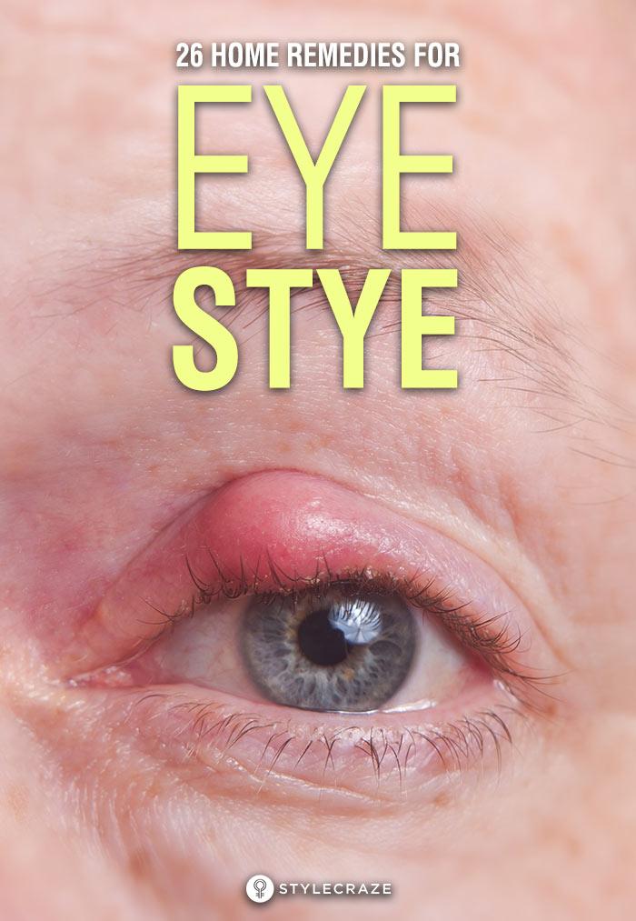 How To Get Rid Of A Stye Under Eyelid Fast Mang Temon