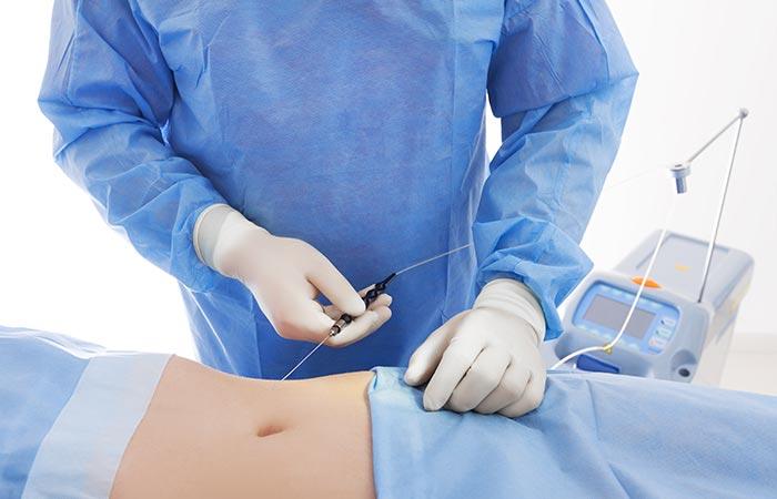 Laser Liposuction Laser Fat Removal To Blast Fat
