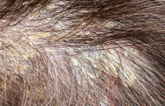 Scalp Buildup Causes, Treatment, And Prevention