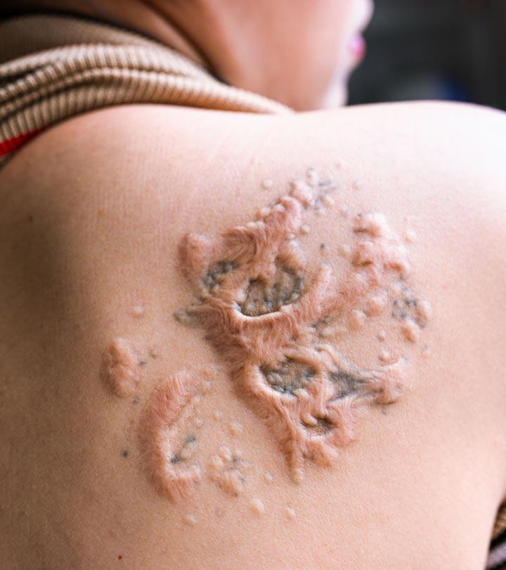 Discover 77+ can people with eczema get tattoos super hot in.eteachers