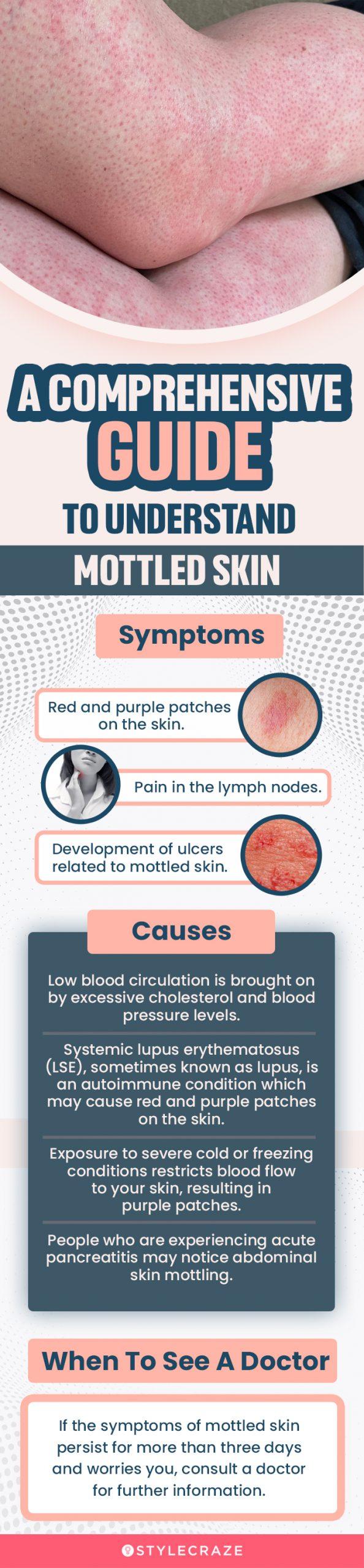 Mottled Skin Causes, Symptoms, Diagnosis, 20 Best