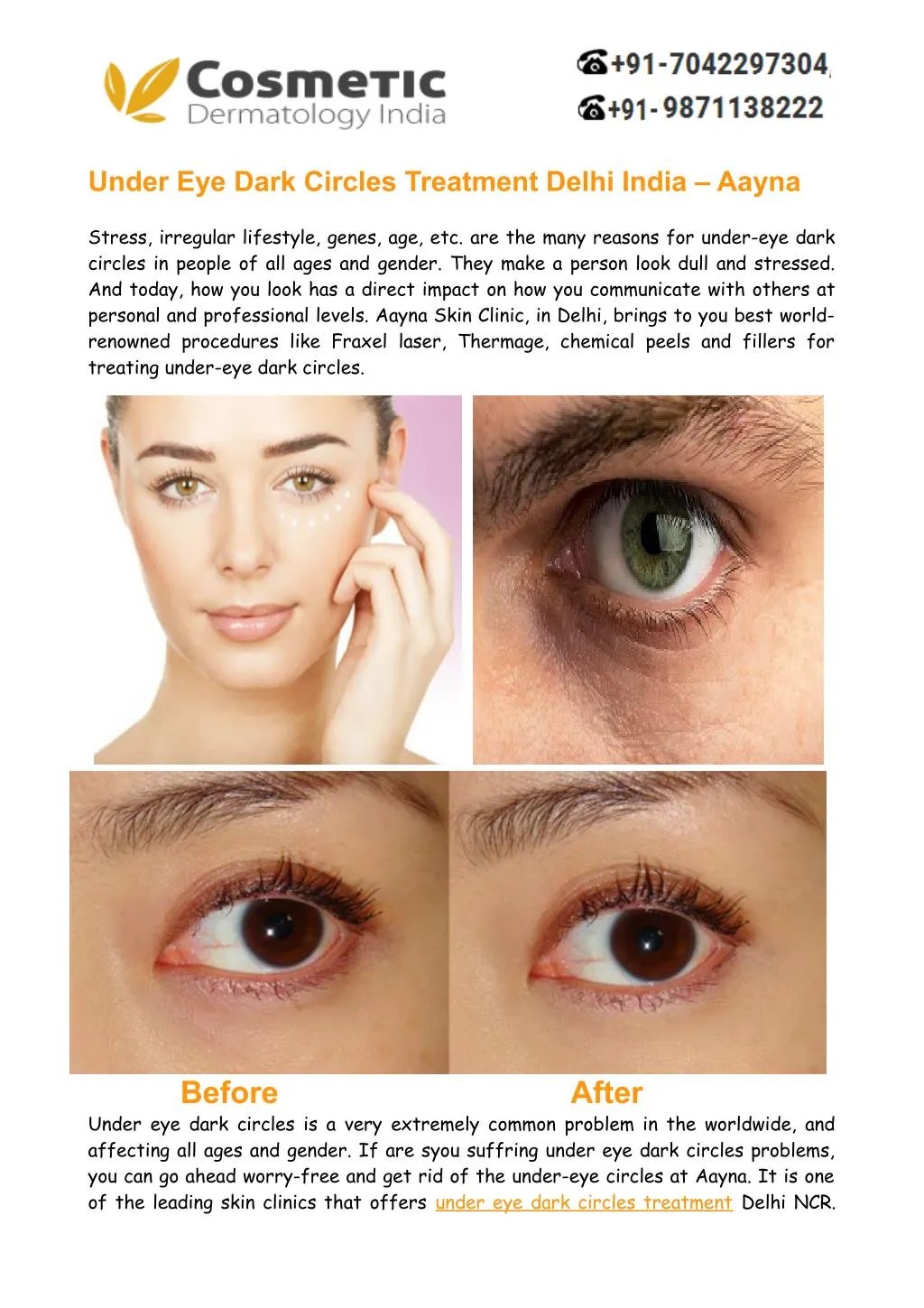 PPT Under Eye Dark Circles Treatment Delhi, India Aayna Clinics