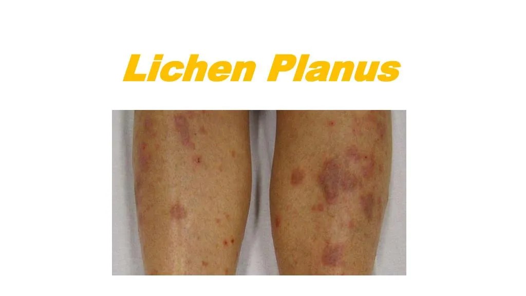 PPT Lichen planus complete knowledge PowerPoint Presentation, free